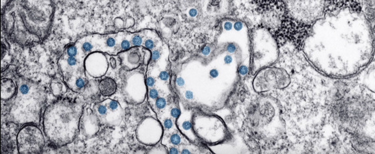 ONU: El coronavirus es una pandemia, pero no es momento de rendirse