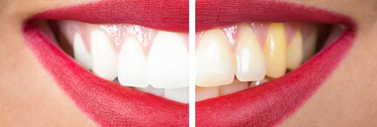 OCU advierte de los riesgos de blanquear los dientes con carbn activado